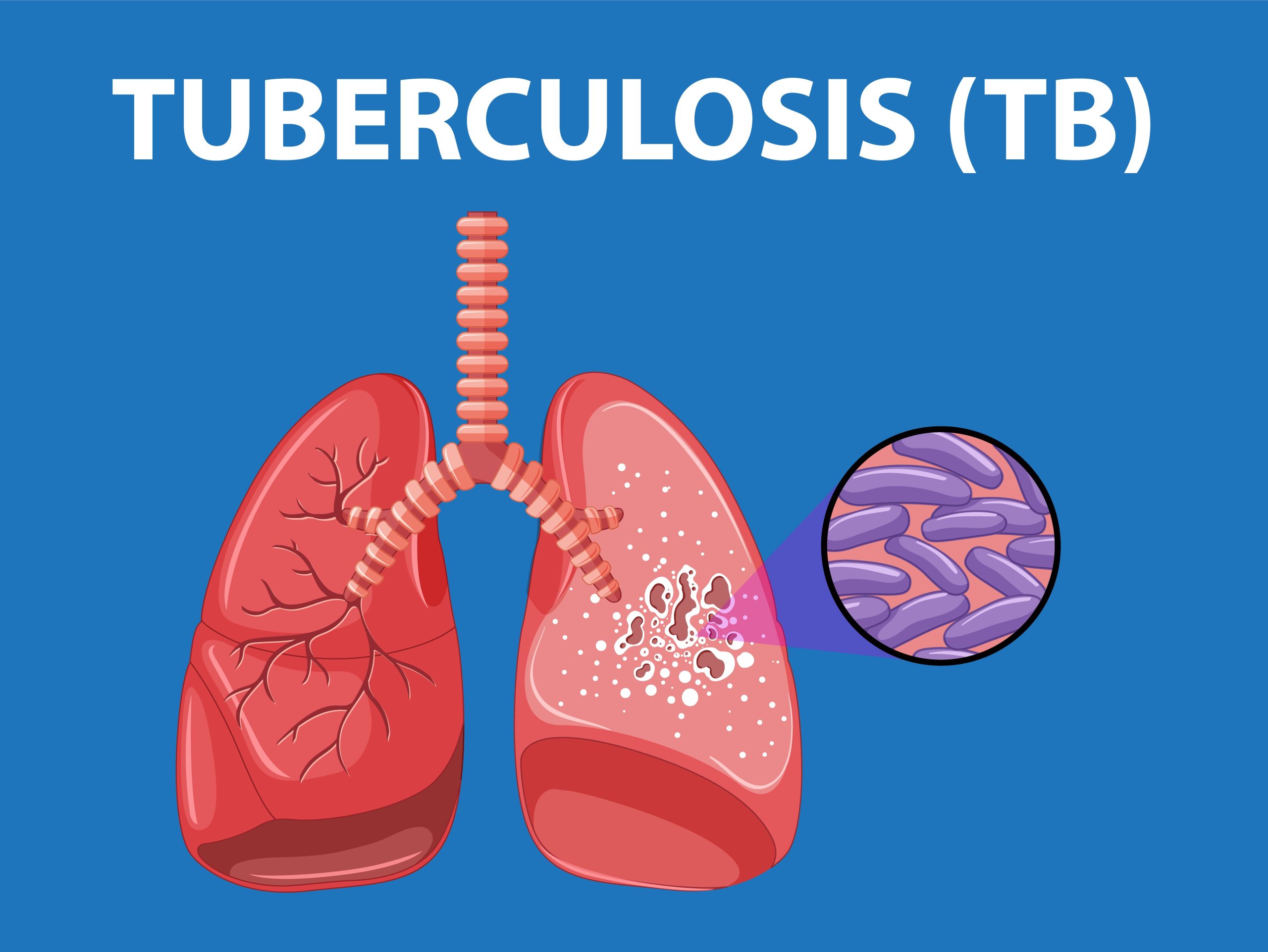 Largest Tuberculosis Outbreak