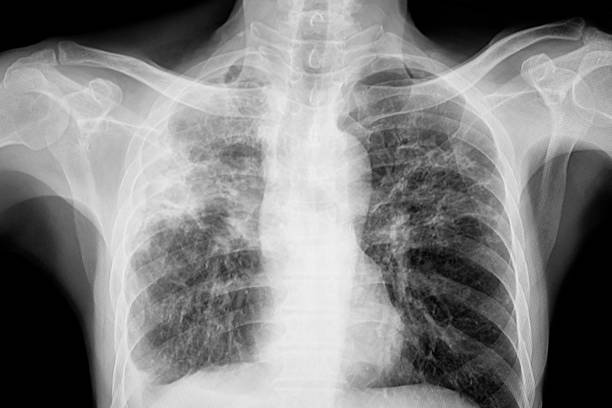 Largest Tuberculosis Outbreak