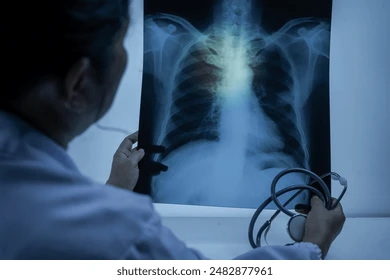 Largest Tuberculosis Outbreak